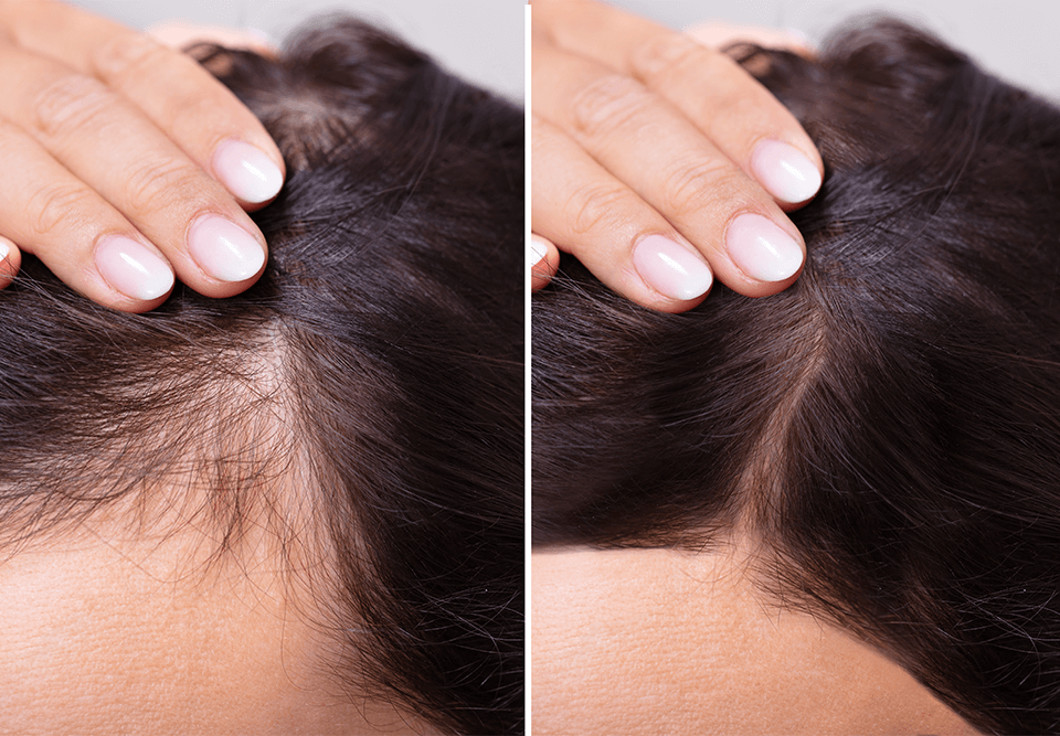 Queda de cabelo excessiva: 5 causas e melhores tratamentos