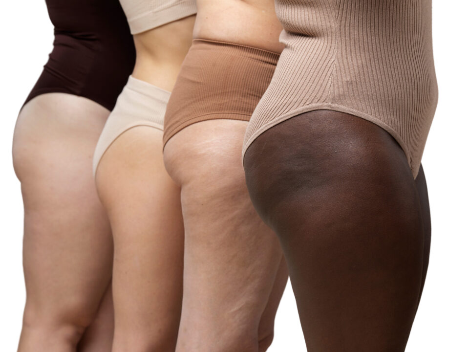 Imagem mostra o corpo de 4 mulheres com furinhos nas pernas e bumbum representando celulite ou lipedema.