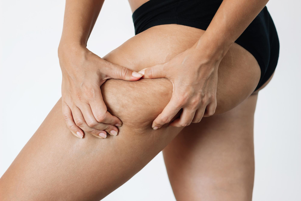lipedema ou celulite