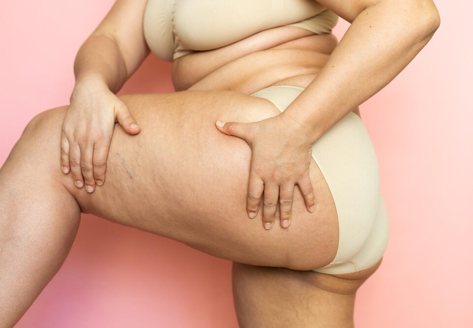 diferença entre lipedema e gordura localizada